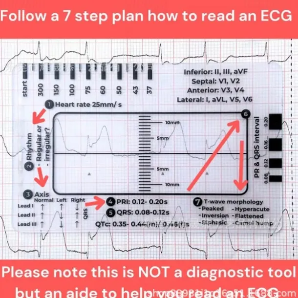 ECG 7 Step Ruler, ECG Ruler Plastic Ruler Measuring Tool, ECG 7 Step Ruler for ECG/EKG Interpretation, Transparent EKG Calipers Measuring Tool, Follow a 7 Step Plan