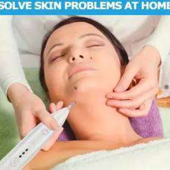 Freckle, Wart, Mole, And Skin Tag Removal Pen - Get Spotless Skin With This Beauty Care Machine