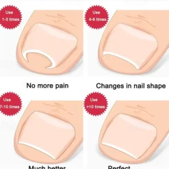 2Pcs Ingrown Toenails Corrector Stainless Steel Nail Straightening Tool Relief Pain Pedicure Tool For Ingrown Toenail Recover